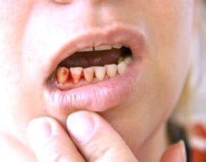 bleeding gums gingivitis and teething in children