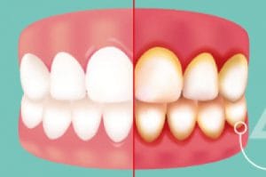 bleeding gums gingivitis and periodontitis and related systemic health issues
