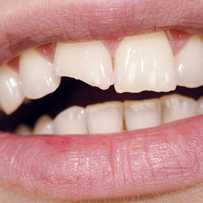 broken chipped or fractured tooth and its restoration