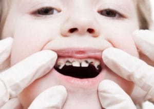 dark spots cavities and decay on children's teeth