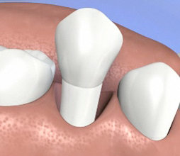 a knocked out or avulsed tooth due to trauma or accident