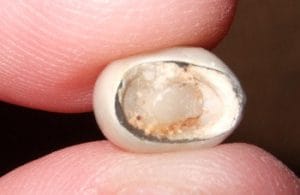 lost crown or cap from a tooth