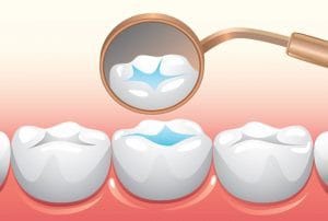 the use of sealants to reduce occurrence of pit and fissure cavities and decay