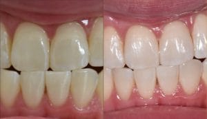 Whitening Before and After