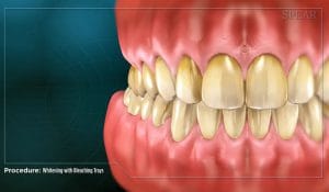 Whitening at home thumbnail
