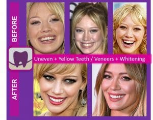 Hillary Duff Before and After