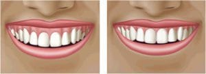 Reshaping Gums