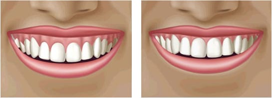 Reshaping Gums