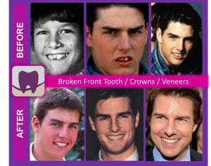 Before and Atter of Tom Cruise's Smile and Teeth