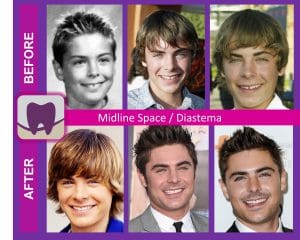 Before and After of Zac Efron's Smile and Teeth