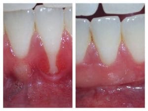 grafting the gums