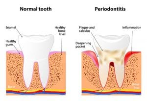 soft tissue graft and periodontitis
