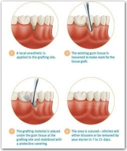 soft tissue graft procedure