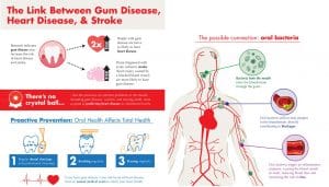 Heart Disease and Gum disease