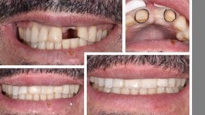 Before and After of an anterior bridge done in less than an hour