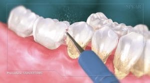 scaling and root planing