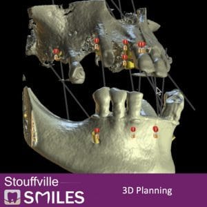 3D planning