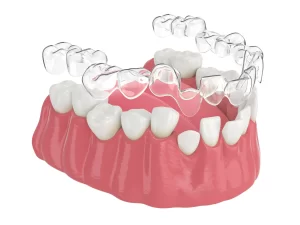 shows clear aligner therapy